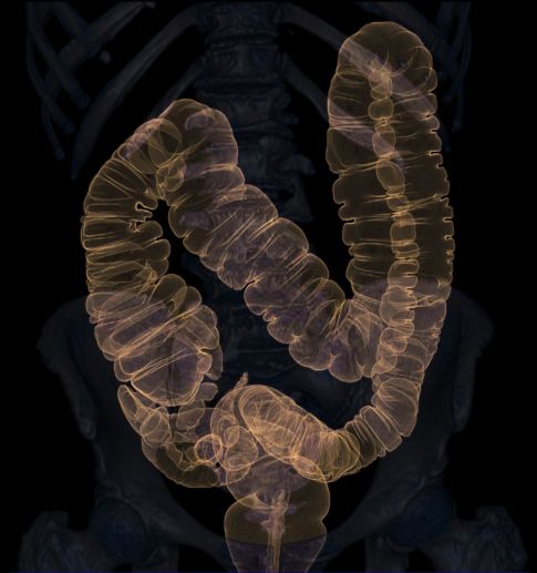 Examen de l'appareil digestif par coloscopie virtuelle 3D à Brest